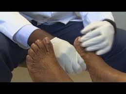 Bioclear Nail Fungus Pen Reviews Treating Nail Fungus Youtube