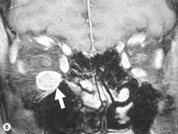 The majority will be proven infectious with special stains for microorganisms. Orbital Disease In Neuro Ophthalmology Sciencedirect