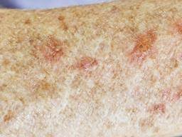 Irritation usually occurs if the growths constantly rub up against clothing. Actinic Keratosis Pictures Causes And Prevention