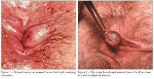 #thrombosedhemorrhoids are painful blood clots that form in an outer hemorrhoid. Anorectal Complaints Office Diagnosis And Treatment Part 1 Consultant360