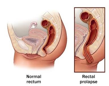 Surgery for rectal prolapse product image