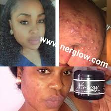 🌺🌿💋Remove acne from your face! The brightening face cream comes in 3  sizes 1oz $152, 2oz $239 and 4oz $289 is