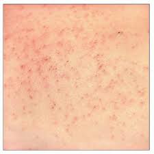 Vellus Hair Cyst Basicmedical Key