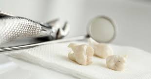 What Can You Eat After A Tooth Extraction Here Are 8 Choices