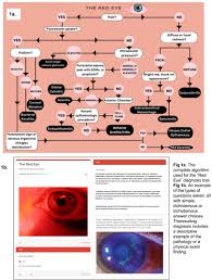 Image result for Acute Red Eye