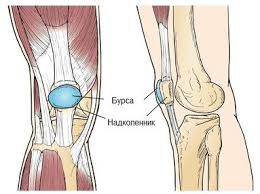 Image result for Prepatellar Bursitis