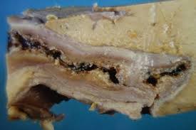 Bovine fasciolosis, fasciola hepatica bovine fasciolosis is an economically important disease of cattle, which can be associated with particular regions throughout. Tumor Like Parasitic Lesions Of The Hepatobiliary Tract Liver Flukes And Other Trematodes Springerlink