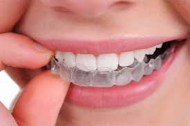 Get Your Mouth Guard For Teeth Grinding In Riverside Invisalign Dental Braces Teeth Straightening