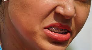 Be sure to floss every day to remove any trapped food, using a floss threader to reach between braces brackets and in the wires. Swollen Gums With Braces What Does It Mean For Your Oral Health