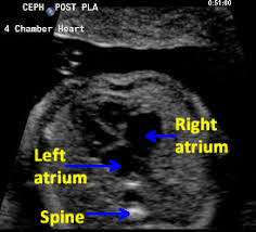 Normal Fetal Heart Ultrasound Ob Images If a fetal heartbeat cannot be identified with a crl ≥7 mm using transvaginal scanning, then embryonal demise can be diagnosed 3,4.demise can be confirmed with repeated scanning and serial. normal fetal heart ultrasound ob images