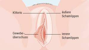 Die paarigen hautfalten zwischen den großen schamlippen, bei vielen mädchen und frauen werden sie. Schamlippenverkleinerung Focus Arztsuche