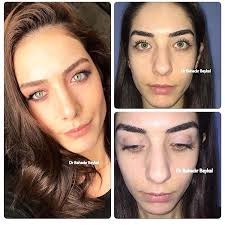 3 789 Likes 169 Comments Rhinoplasties Rhinoplasties On Instagram Wow Comment Below If You Need Rhinoplasty Nose Surgery Rhinoplasty Facial Surgery