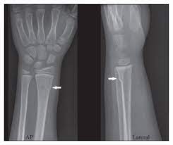 We did not find results for: Buckle Fractures Of The Distal Radius In Children Cmaj