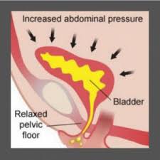 Image result for Stress Incontinence