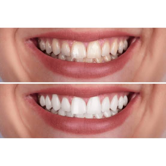 Teeth Whitening in Algonquin, IL | Professional Zoom Whitening | Catara Med  Spa