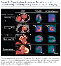 Of cardiology, maastricht university medical centre. Arrhythmogenic Inflammatory Cardiomyopathy A Review Aer Journal