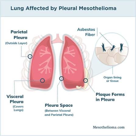 CT scan showing pleural mesothelioma