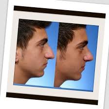 It's available for mac, windows, android, and ios. Rhinoplasty And Nose Job 1 0 2 Apk Download Android Health Fitness Apps Apk Downloader