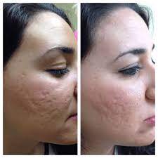 A combination of physical and chemical exfoliation is the secret behind this resurfacing polish.using pumpkin enzyme, aluminum oxide crystals, and aha, it smooths the look. Microneedling Orlando Eclipse Micropen Orlando