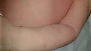 Image result for sweat rash on back baby