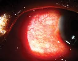 Image result for lesion sclera
