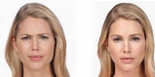 Please mark diagram (above) with number of units at each injection area as a history of the dosage per area. Botox Treatment For Wrinkles Dermatologists In Elizabethtown Kentucky