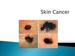 Abnormal cells grow and can form tumors. Ppt Drill Powerpoint Presentation Free Download Id 2017068