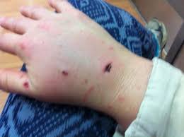 Image result for Cat Bite