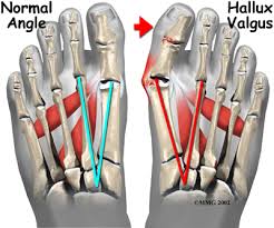 Image result for Hallux Varus