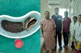 Batu empedu awalnya terbentuk dari kolesterol dan biasanya tidak menunjukkan gejala tertentu. Ada 4 100 Batu Empedu Dalam Tubuhnya Ini Yang Ia Rasakan Bertahun Tahun Semua Halaman Nakita