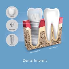 The dental implants will continue to integrate over the next several months, but because of our unique protocols and milling center, you enjoy the benefits of permanent, fully functioning can i take money from my ira (individual retirement account) to help pay for the golpa g4 implant solution? Monroe La Dental Implants
