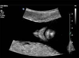 The most common indication for performing a karyotype leading to the diagnosis of trisomy 13 is identification of abnormal clinical features on ultrasound, followed by advanced maternal age. The Sonographic Detection Of Trisomy 13 Iame