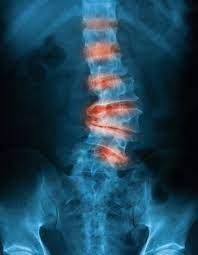 Spondylose Wirbelsaulen Verschleiss Alles Wichtige Dazu Liebscher Bracht