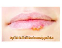 Most cold sore remedies only manage the problems the best way to get rid of cold sores fast is to talk to your doctor about getting a prescription for an antiviral treatment such as How To Get Rid Of A Cold Sore Overnight Cold Sore How To Stop Cold Sores Cold Sore Lip By Independent Issuu