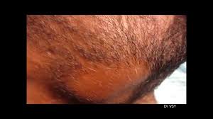 And, this could just be the tip of the iceberg. Bald Patch In Beard Youtube