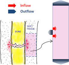 Inside the diaphysis is the medullary cavity, which is filled with yellow bone marrow in an adult. Simplified Scheme Of A Fractured Long Bone Left And A Geometric Model Download Scientific Diagram
