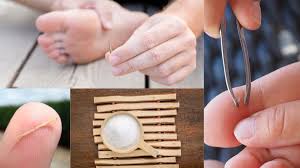 This will soften the skin and ring the splinters to the surface. How To Remove A Deep Splinter With Epsom Salt Helth