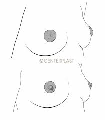 Image result for Nipple Inversion