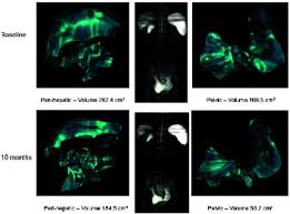 mesothelioma types, risks, diagnosis, and treatment. Indolent Peritoneal Mesothelioma Pi3k Mtor Inhibitors As A Novel Therapeutic Strategy Esmo Open