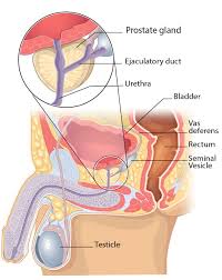 The pancreas is an organ that releases enzymes involved with digestion, and hormones to regular blood sugar levels. Pathophysiology Nur 7450 Prostate Cancer