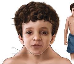 Noonan syndrome: improving recognition and diagnosis