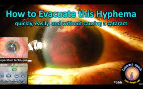 Image result for Hyphema