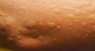 Image result for Hives