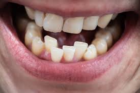 Misaligned Teeth