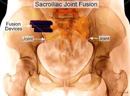 Annotated Color X Ray Sacroiliac Joint Fusion Sacroiliac Sacroiliac Joint Joint