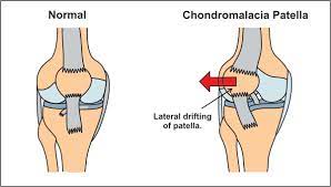 Chondromalacia Patella : Causes , Symptoms , Diagnosis , Treatment