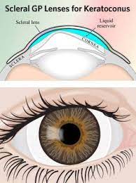 Scleral Lenses Have Many Uses Including In The Movies Contact Lenses Gas Permeable Contact Lenses Lenses