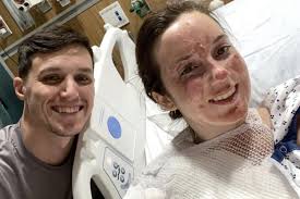 I was forced to call off my wedding after fire melted my face