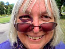 Eking meaning from my first black eye