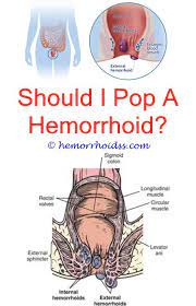 Pin On Hemorrhoids Cure